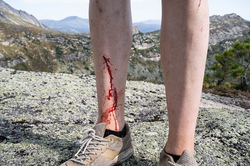 bleeding leg of a hiker